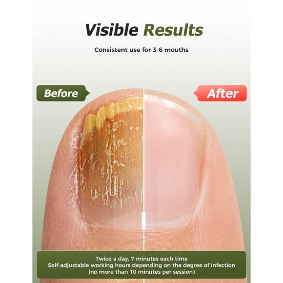 Multi-Nail Fungus Light Device - Foldable Home Care for Discolored & Thickened - Picture 4 of 4